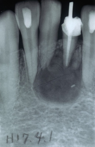 歯根 嚢胞 治療